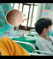 308准分子治疗仪使用方法